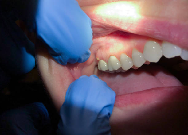 Best Emergency Dental Extractions in Trafalgar, IN