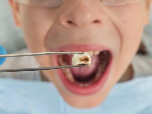 Best Emergency Dentist for Lost Fillings or Crowns in Trafalgar, IN